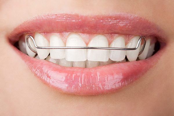How braces improve bite and jaw alignment