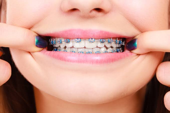 How braces improve bite and jaw alignment