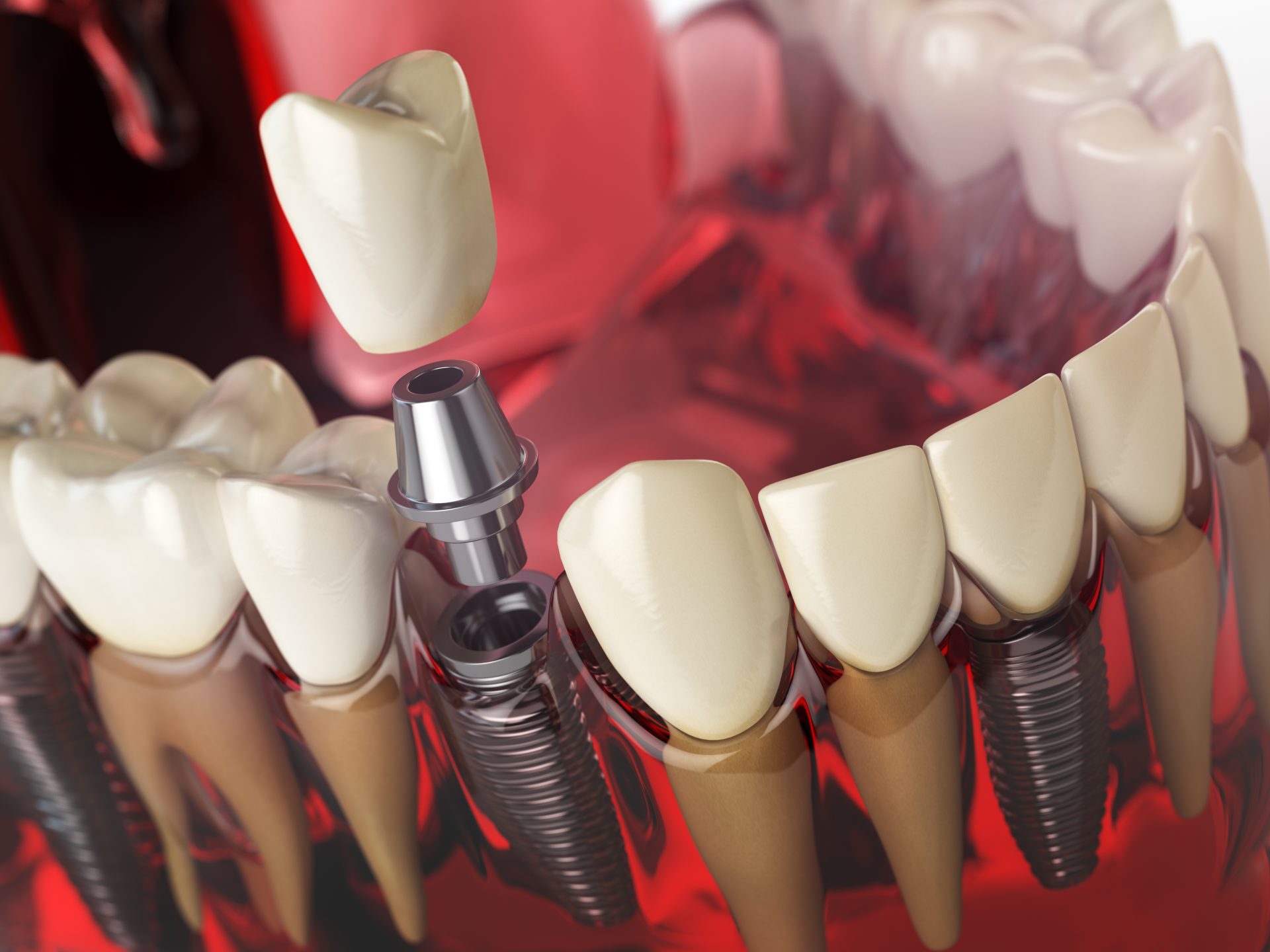 Long-Term solution for missing teeth: Why Dental Implants Are Worth Considering