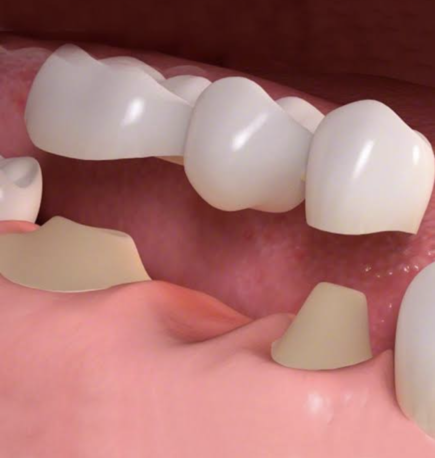 Dental Fixed Bridge in Castle Hill