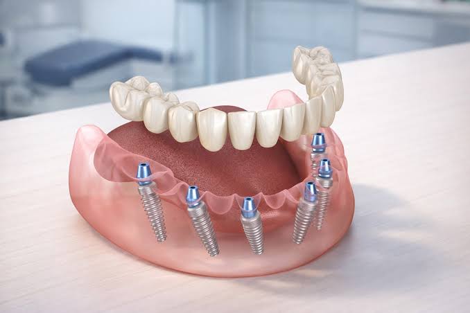 All-on-6 Dental Implants in Sydney City