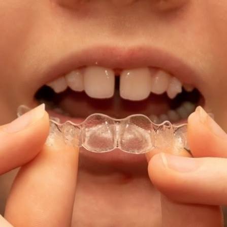 Invisalign in Parramatta