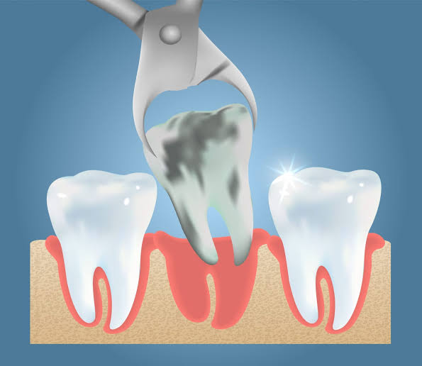 Dental Extraction in Chatswood 